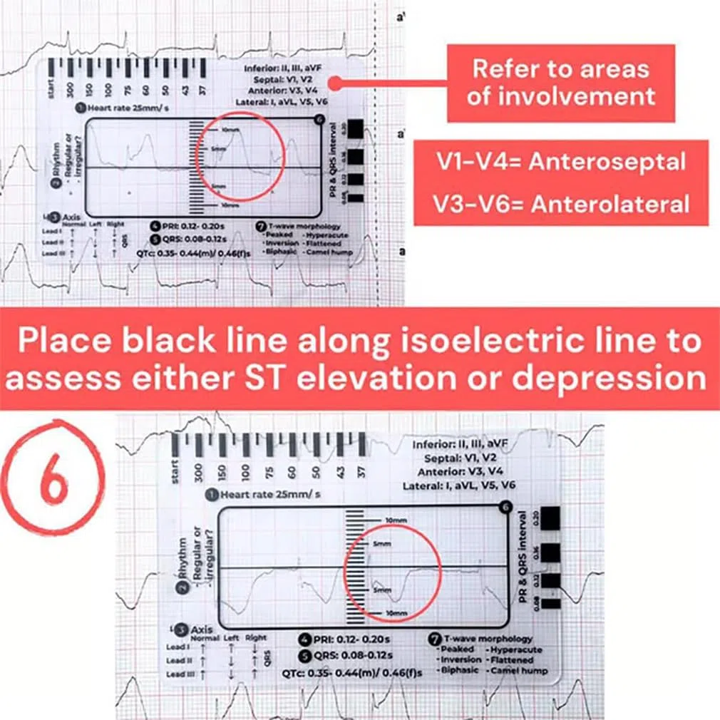 2 sztuki linijki EKG z 7 krokami, karta linijki EKG przezroczyste narzędzie pomiarowe EKG, 7-stopniowa interpretacja EKG/EKG, narzędzie pomiarowe dla rodzin, studentów, ratowników medycznych